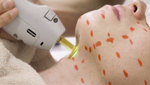 メンズリゼのヒゲ脱毛